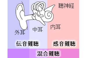 障害位置による難聴の分類